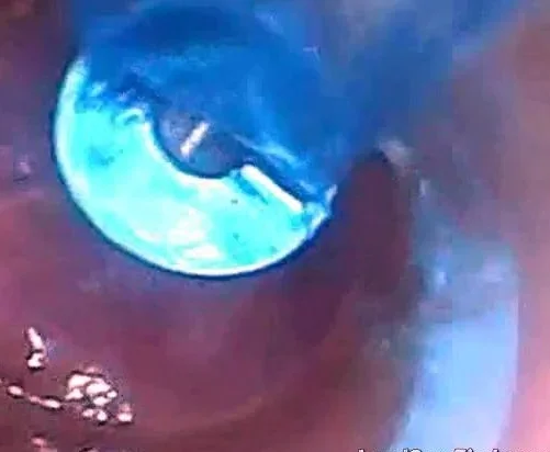 Endoscope POV: Test Tube Cock Urethral Insertion