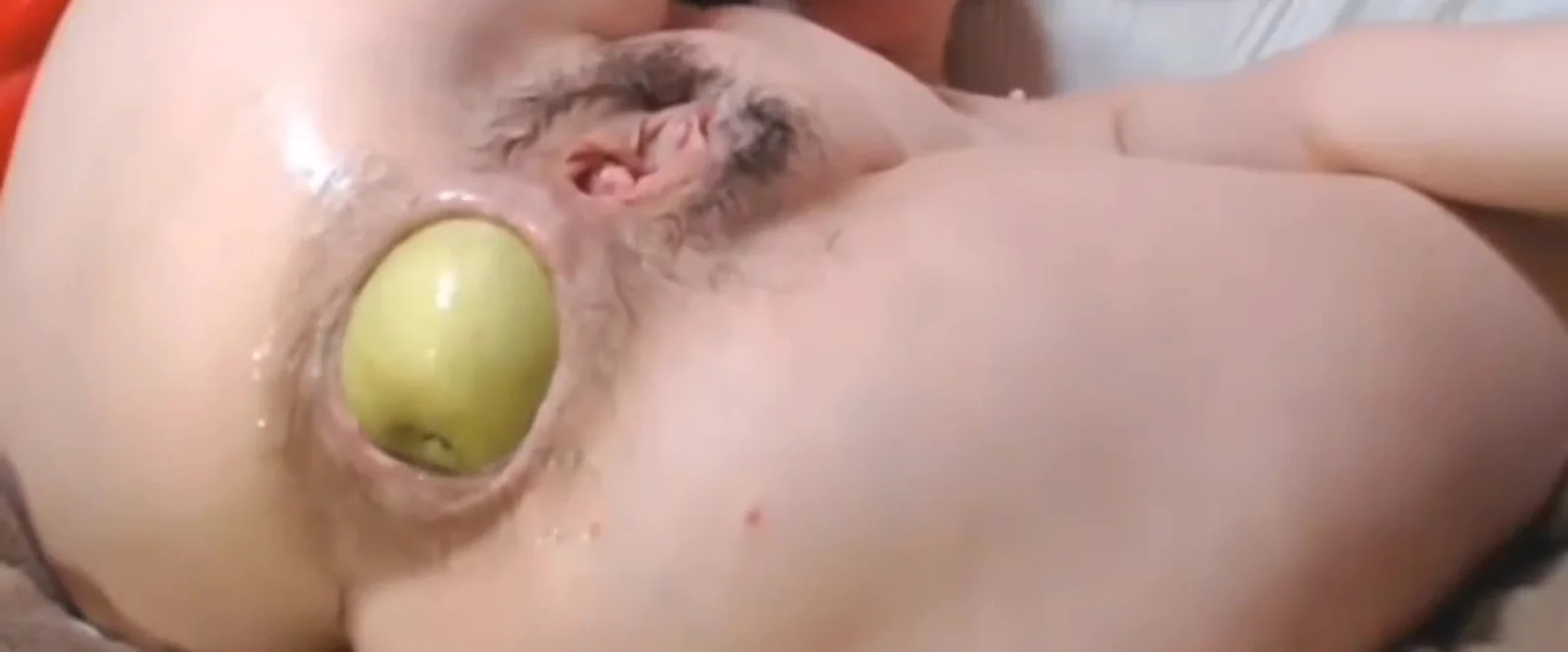 Extreme Anal Prolapse Wife On Webcam