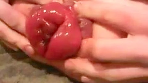 Monster prolapse